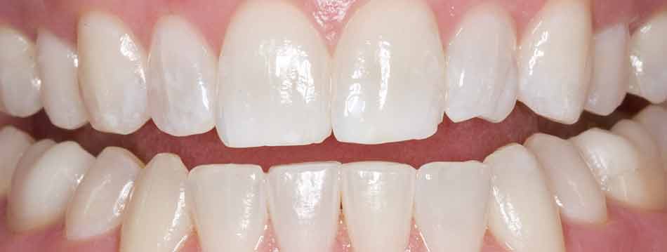 White Teeth After Opalescence