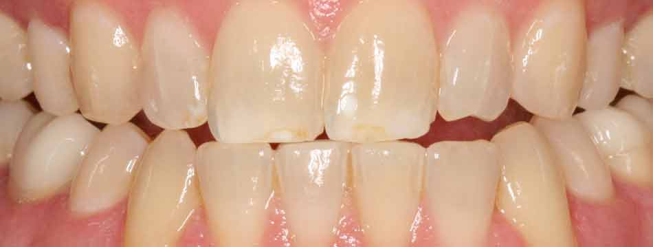Yellow Teeth Before Opalescence