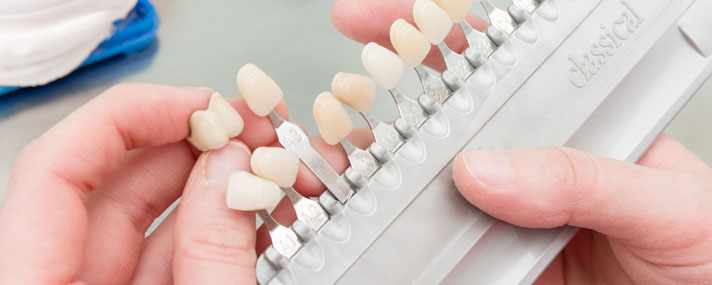 Tooth Color Matching