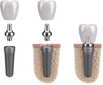 Dental Implant Illustration