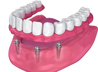 Implant Supported Dentures - All on Four