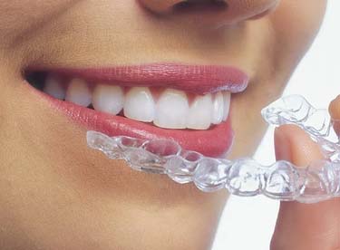 Invisalign Retainer Near Adult Mouth