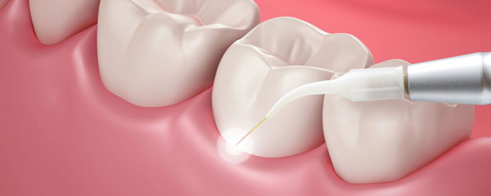 laser-dentistry-illustration