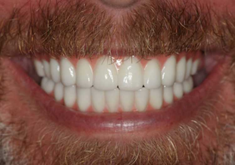 After All On 4 Dental Implants Placed