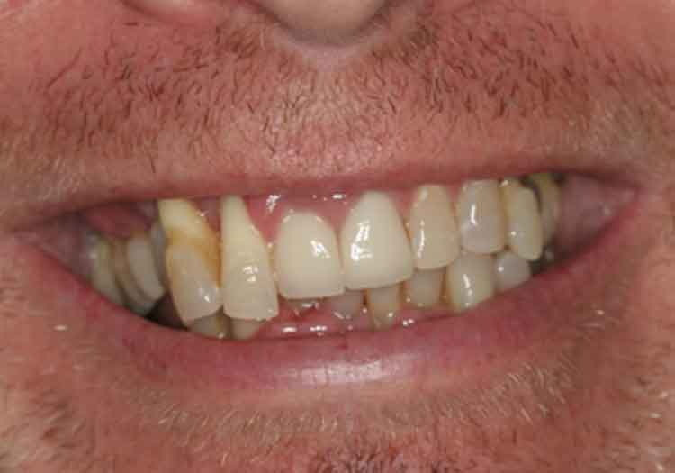 Before All On 4 Implants