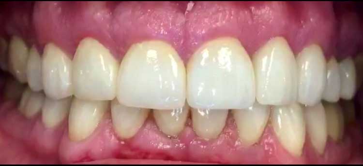 After Tooth Decay Teeth