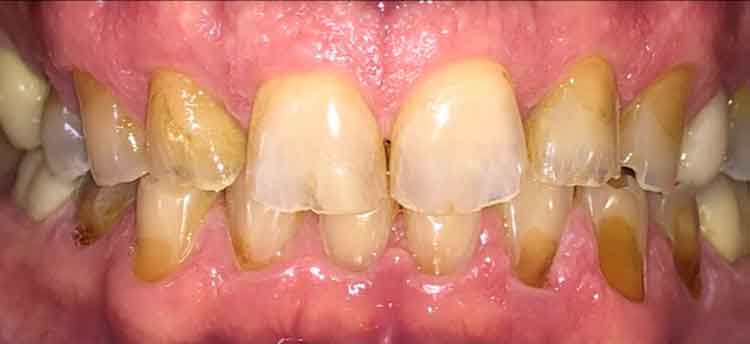 Tooth decay Before Photo