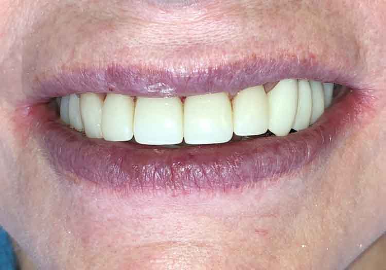 Dental Implants After