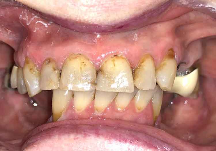 Before Full Mouth Dental Implants