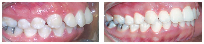 Smile Before & After Photo