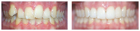 Smile Before & After Photo