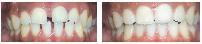 Smile Before & After Photo