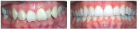 Smile Before & After Photo