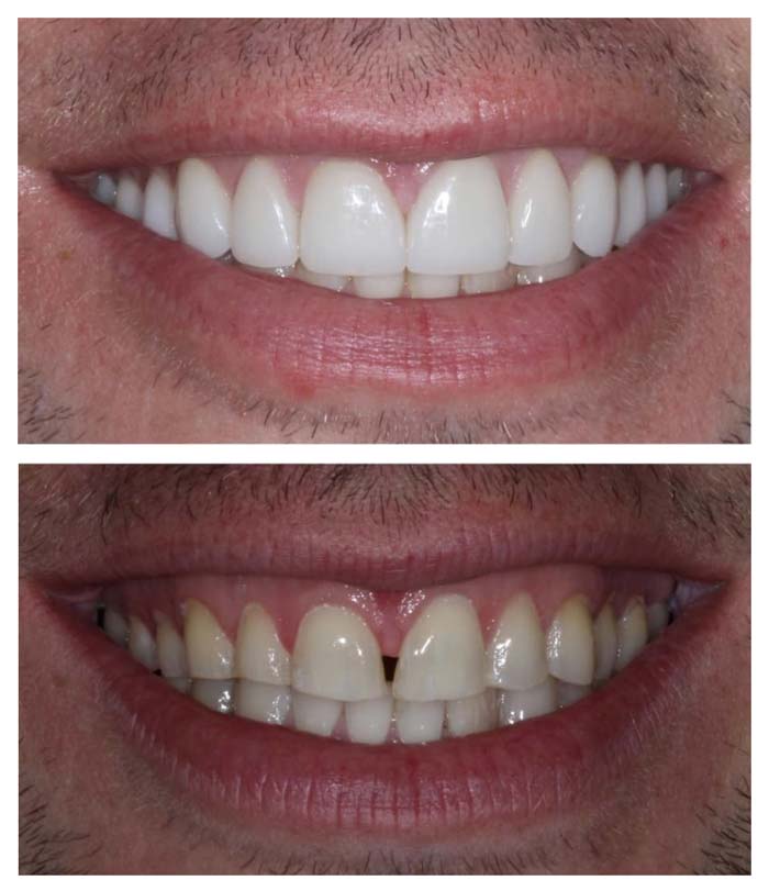 Before & After - Cosmetic Dentistry Smile Makeover