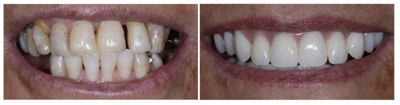 Before & After Implants Smile