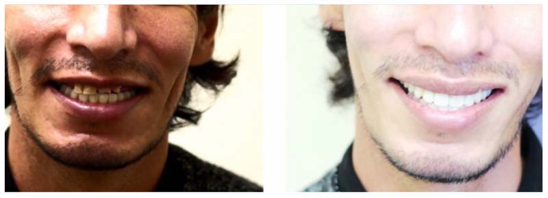 Before & After Dental Implants