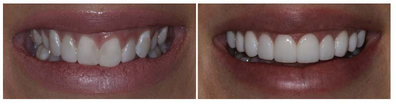 Cosmetic Smile Makeover 3
