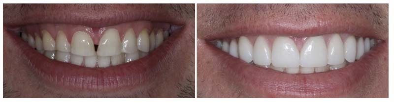 Cosmetic Smile Makeover 4