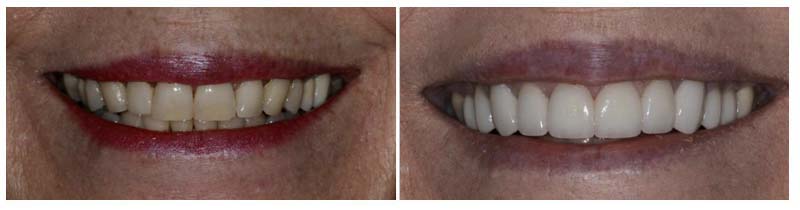 Cosmetic Smile Makeover 5