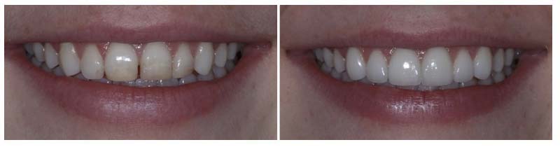Cosmetic Smile Makeover 6