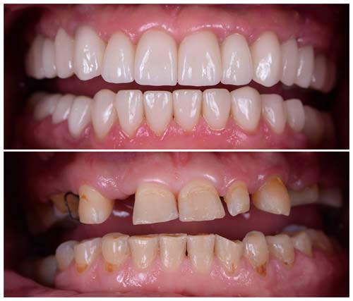Full Mouth Dental Implant Before & After Photo