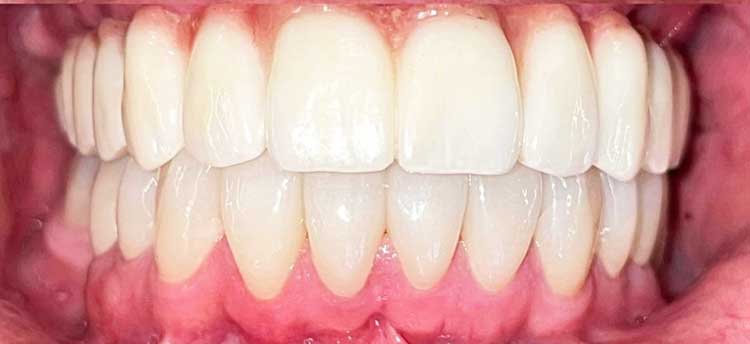 Full Moth Dental Implants From Berkeley Hills Dentist
