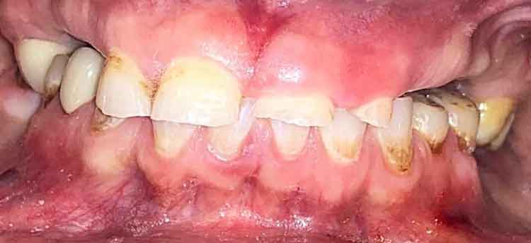 Before Full Moth Dental Implants From Berkeley