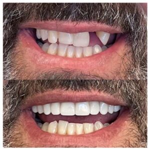 Before & After Dental Implants Patient 1
