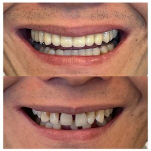 Before & After Dental Implants Patient 3