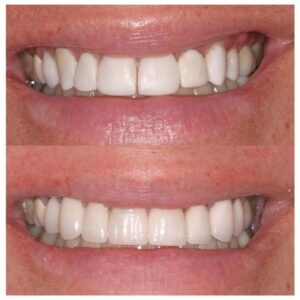 Before & After Dental Implants Patient 4