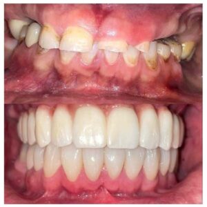 Before & After Dental Implants Patient 5