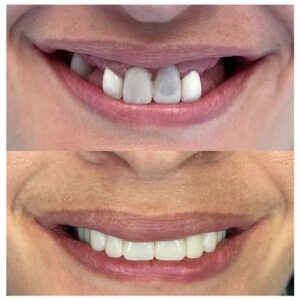 Before & After Dental Implants Patient 6